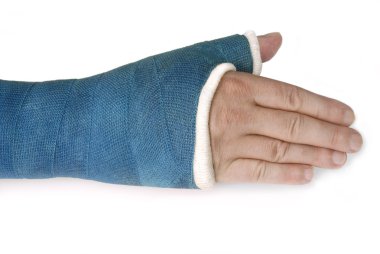 Broken wrist, arm with a blue fiberglass cast clipart