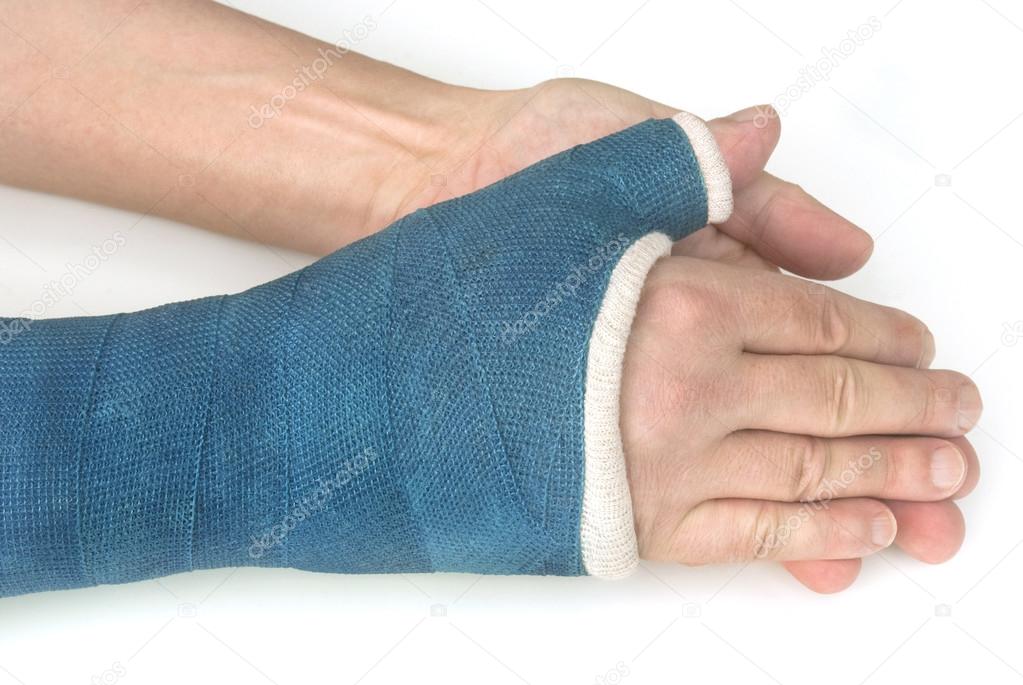 Broken wrist, arm with a blue fiberglass cast on a white background