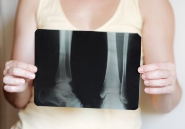 x-ray görüntü bacak