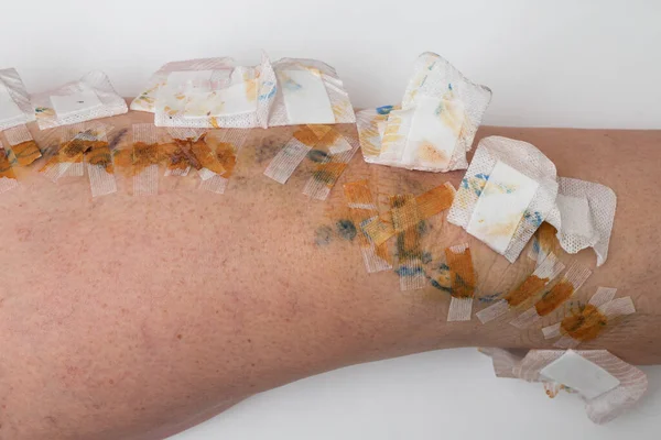 Πόδι Λευκά Έμπλαστρα Μετά Από Θεραπεία Κιρσούς — Φωτογραφία Αρχείου