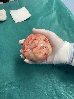 Çıkarıldıktan sonra büyük bir rahim fibroidi düğümü
