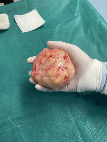 Çıkarıldıktan sonra büyük bir rahim fibroidi düğümü