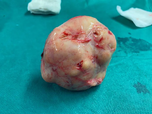 除去後の子宮筋腫の大部分は ストックフォト
