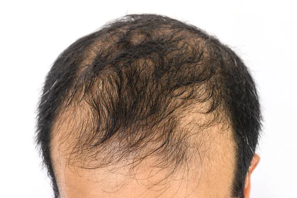 Close Male Pattern Baldness Typically Appears First Hairline Top Head — Stock Photo, Image