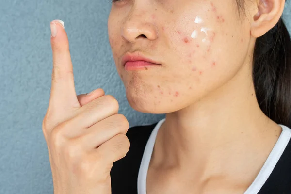Cropped Shot Woman Half Face Acne Inflammation Papule Pustule Her — Stock Photo, Image