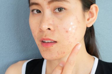 Yüzünde sivilce iltihabı (Papule ve Pustule) olan bir kadının portresi ve tedavi için yüzüne sivilce kremi sürmesi. Kadın tenindeki sorunların kavramı.