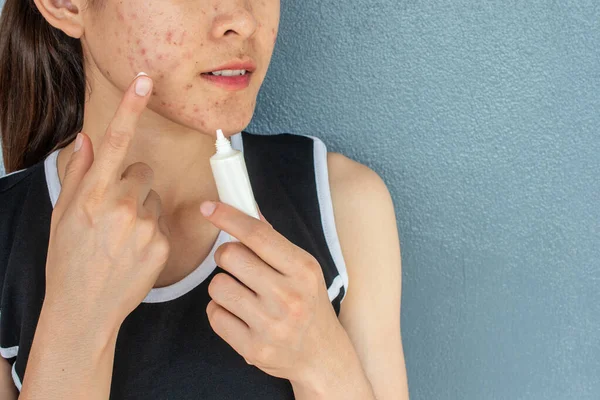 Portrait of woman with acne inflammation (Papule and Pustule) on her face and she trying to applying acne cream on her face for treat. Conceptual of problems on woman skin.