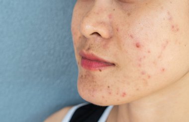 Yüzünde sivilce iltihabı (Papule ve Pustule) olan yarım yüzlü bir kadın. Kadın tenindeki sorunların kavramı.