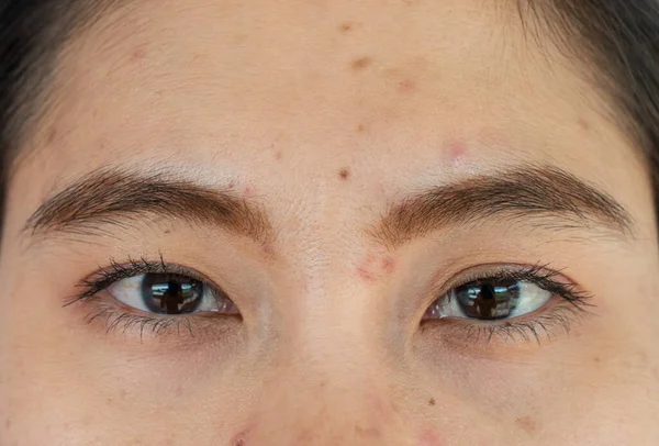 Close up of woman face with the problem of Acne and Scar from acne inflammation (Papule and Pustule) on her forehead. Conceptual of problems on woman skin.