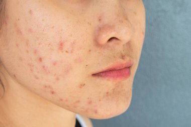 Yüzünde sivilce iltihabı (Papule ve Pustule) olan yarım yüzlü bir kadın. Kadın tenindeki sorunların kavramı.