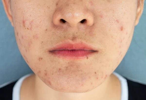 Close-up of woman half face with problems of acne inflammation (Papule and Pustule) on her face. Conceptual of problems on woman skin.