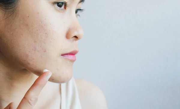 Retrato Una Joven Asiática Con Problemas Acné Conceptual Mujer Tratando — Foto de Stock