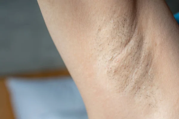 Close Woman Showing Her Unshaved Armpit Unshaven Women Often Meet — Stock Photo, Image