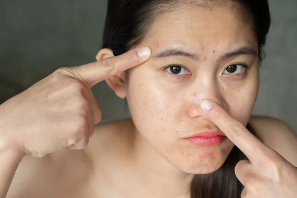 在她的脸上出现了亚洲女人指着痤疮问题的画像 女性皮肤上出现问题的概念镜头 — 图库照片