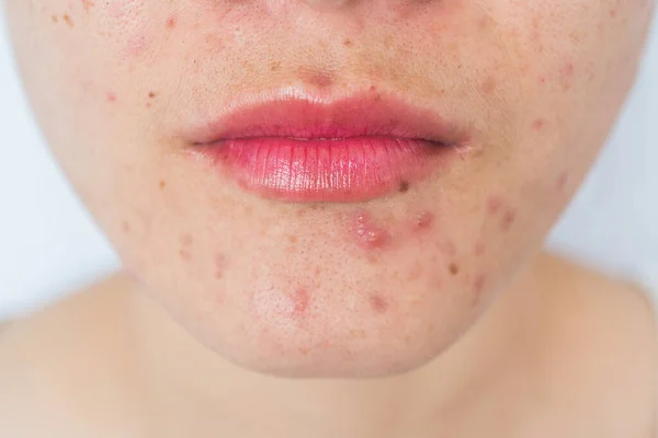 Close up of woman half face with problems of acne inflammation (Papule and Pustule) on her face. Conceptual of problems on woman skin.