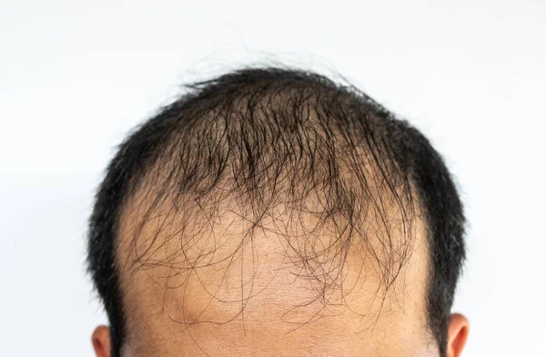 Asyalı erkek kelliğine yakın çekim. Saç kaybı (alopecia) sadece kafa derinizi ya da tüm vücudunuzu etkileyebilir. Kalıtım, hormonal değişiklikler ya da yaşlanmanın normal bir parçası olabilir..