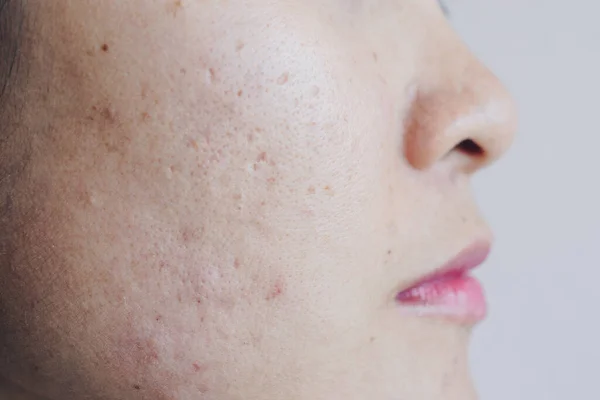 Close Asian Woman Face Has Problems Aging Skin Acne Scar — Stock Photo, Image