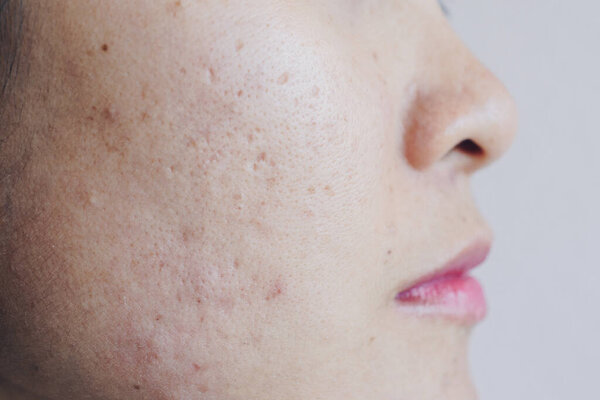 Close up of Asian woman face has problems with aging skin/acne scar on her face. Problems with acne and scar on the female skin.