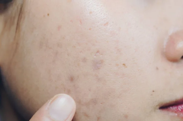 stock image Close up of Asian woman face has problems with skin on her face. Problems with acne and scar on the female skin.