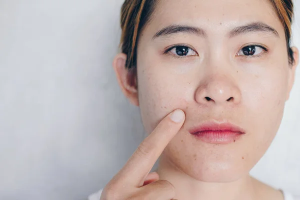 Portrait Asian Woman Pointing Her Face Has Problems Skin Acne — Stock Fotó