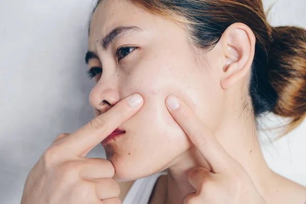 Portrait Asian Woman Worry Pointing Her Face Has Problems Skin — Stockfoto