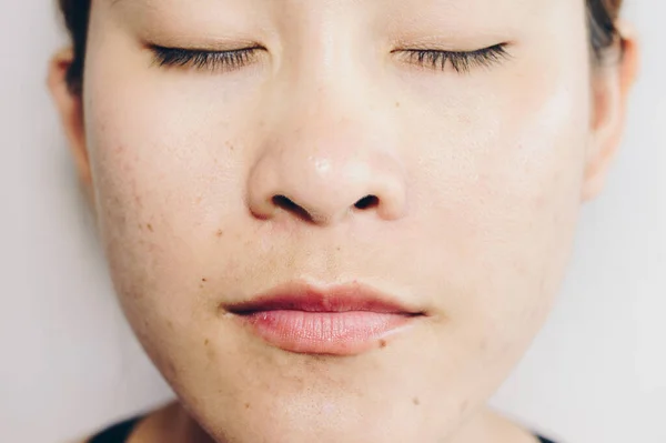 Close Asian Woman Has Problems Skin Her Face Problems Acne — Stock Fotó