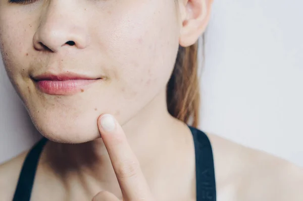Närbild Asiatisk Kvinna Har Problem Med Huden Ansiktet Problem Med — Stockfoto