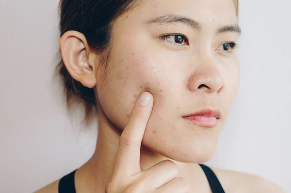 Potret Wanita Asia Memiliki Masalah Dengan Kulit Wajahnya Foto Konseptual — Stok Foto