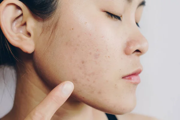 Portrait Asian Woman Has Problems Skin Her Face Conceptual Shot — Stock Photo, Image