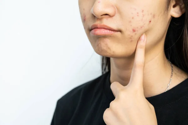 Cropped shot of woman pointing to an acne problem on her cheek. Inflamed acne consists of swelling, redness, and pores that are deeply clogged with bacteria, oil, and dead skin cells.