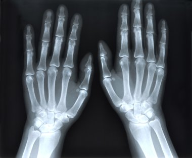 insan elinin x-ray görüntüsü