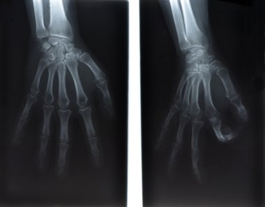 insan elinin x-ray görüntüsü