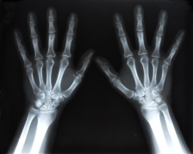 insan elinin x-ray görüntüsü