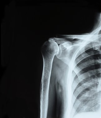 omuz eklemi x-ray