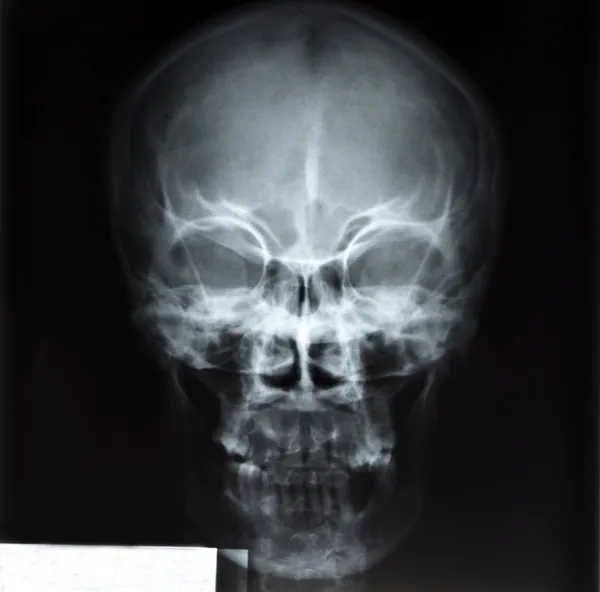 Skull x-rays image — Stock Photo, Image