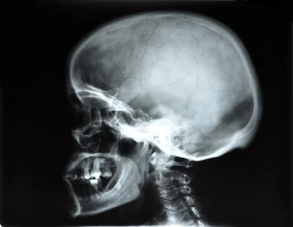 Skull x-rays image sagital plane — Stock Photo, Image