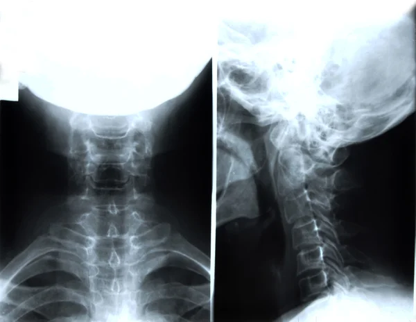 Detail of neck and head x-ray image — Stock Photo, Image