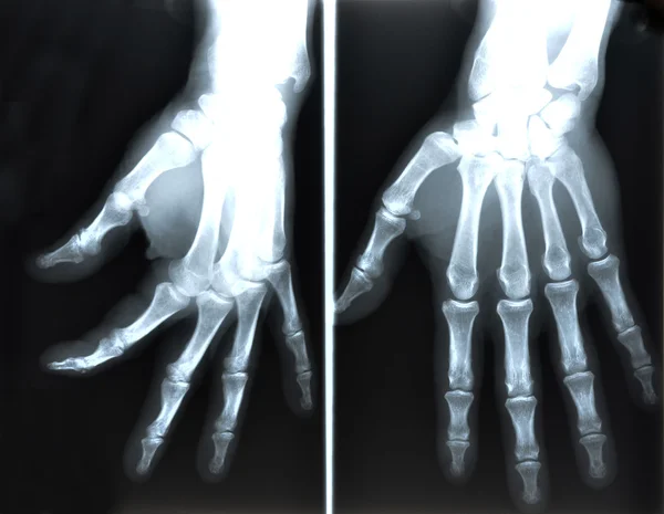 X-Ray image of human hands — Stock Photo, Image