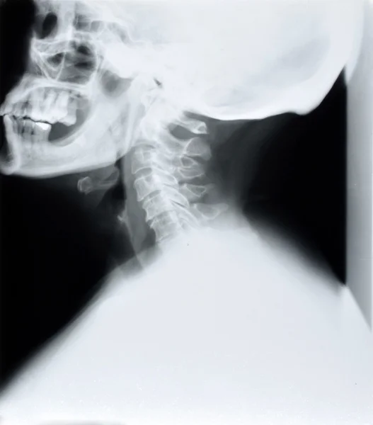 Detail of neck and head x-ray image — Stock Photo, Image
