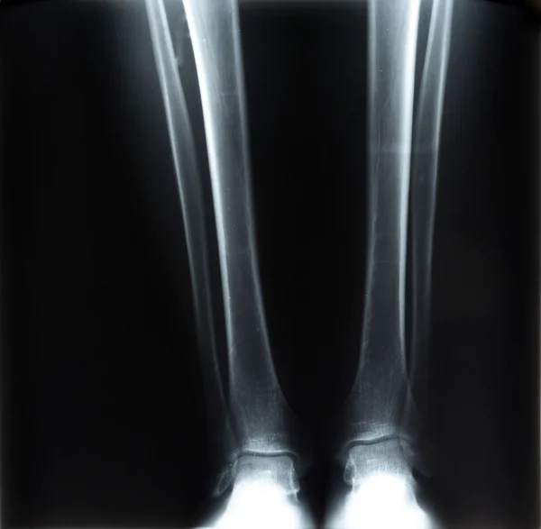 Her iki insan ayağı x-ray — Stok fotoğraf