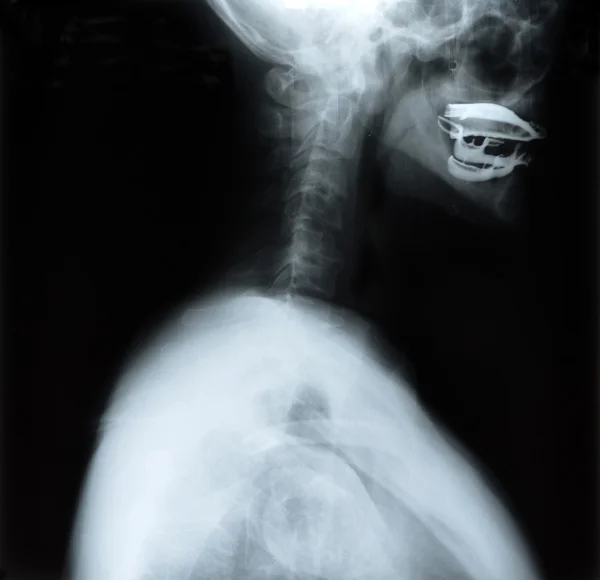 Detail van de nek en hoofd x-ray afbeelding — Stockfoto