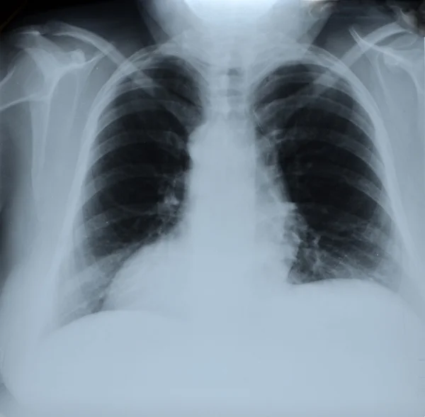 Xray chest of lung cancer patient Stock Photo by ©stockdevil_666 61372651