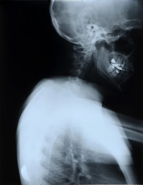 Detail of neck and head x-ray image — Stock Photo, Image