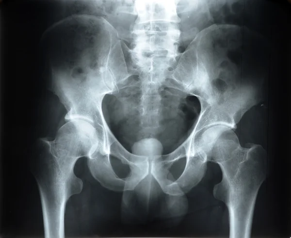 Radiograph of the pelvis — Stock Photo, Image