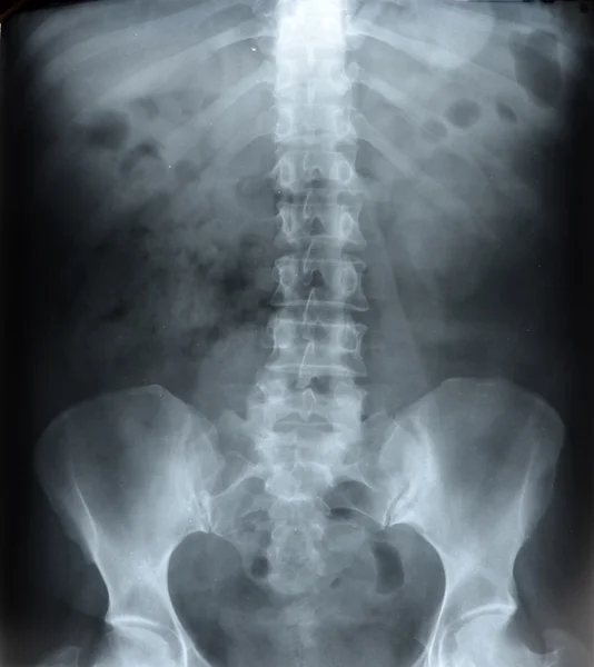 Radiografi av bekkenet – stockfoto