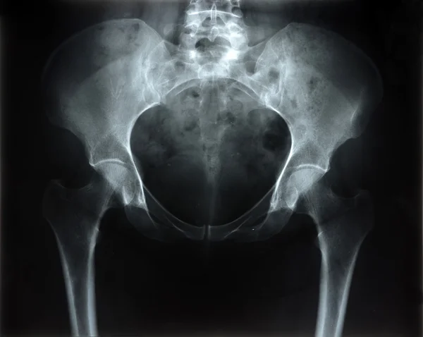 骨盤のレントゲン写真 — ストック写真