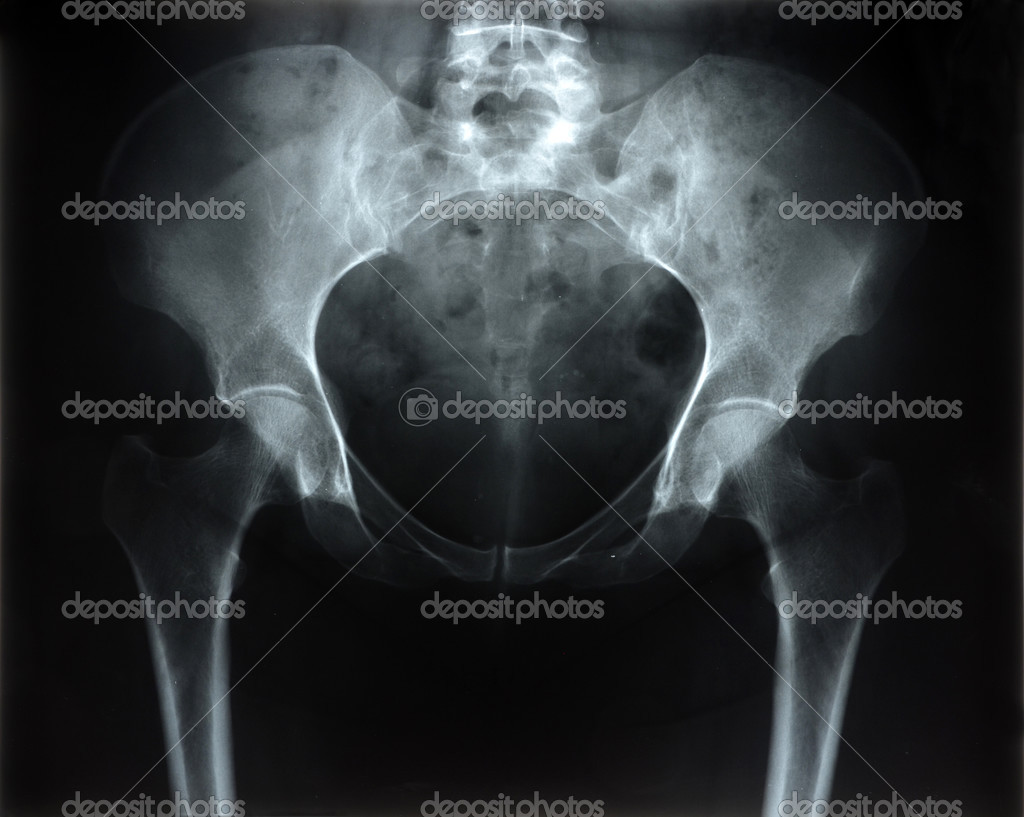 Radiographie du bassin image libre de droit par neftali77 © #34240911