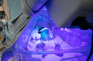 Yeni doğmuş bebek, kuluçka makinesinde ultraviyole ışık altında sarılık tedavisi görüyor. Yenidoğan bebekleri için yoğun bakım ünitesi (NICU), yoğun bakım (ICN)