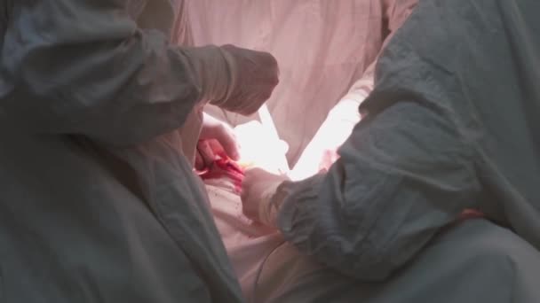 Mâinile Unui Medic Chirurg Care Efectuează Operații Aterom Distanță Capul — Videoclip de stoc