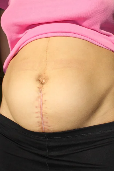 Seams after the operation of Caesarian section — Stock Photo, Image